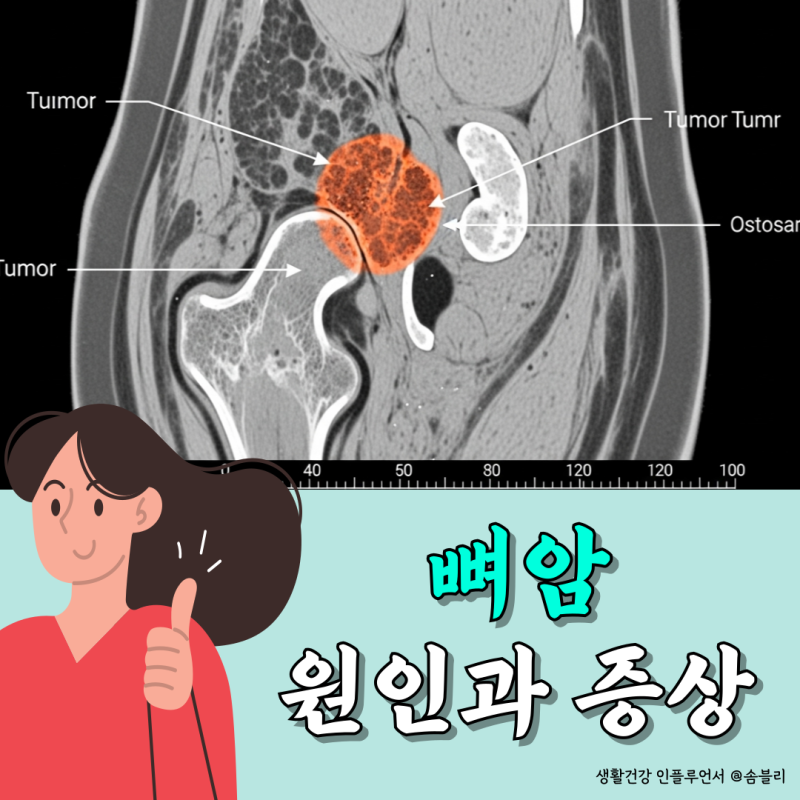 생소한 뼈암, 뼈암증상 초기에 알 수 있을까?