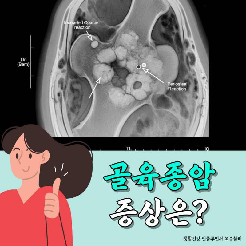 골육종암 골육종증상 초기에 알 수 있을까?