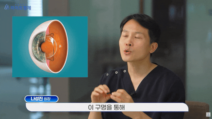 ICL 렌즈삽입술 부작용에 대한 진실