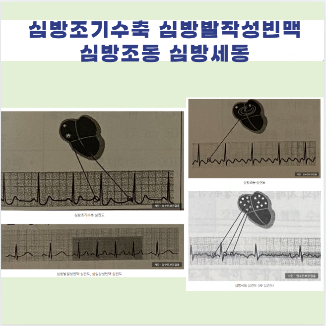 P파 부정맥 심방조기수축 심방발작성빈맥 심실상성 빈맥 심방조동 심방세동 의학용어 PAC APT ....