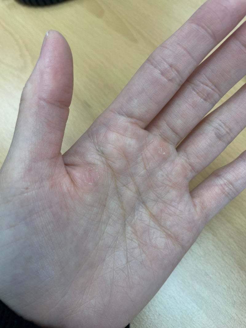 손바닥 사마귀 냉동치료 4탄 | 드디어 종결