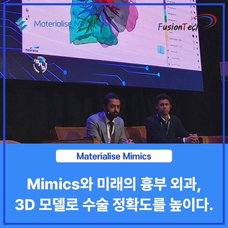  [Materialise S/W] Mimics와 미래의 흉부 외과, 3D 모델로 수술 정확도를 높이다.