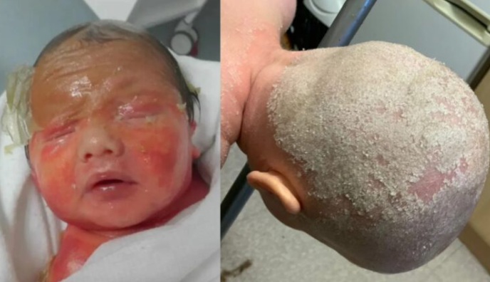   태어날 때 ‘노란 피부막’에 싸여 태어난 아기… 전 세계 30만 명 중 단 1명꼴의 기적 같은 생존기 