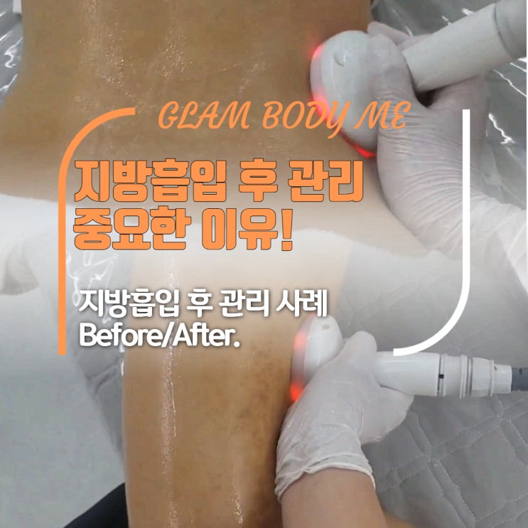  지방흡입후관리 후기, 붓기 바본 완화 비포 & 애프터 (2주 차 - 5주 차)