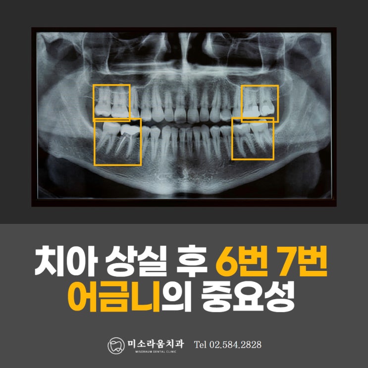  강남역 임플란트 치과, 6번 7번 어금니의 중요성