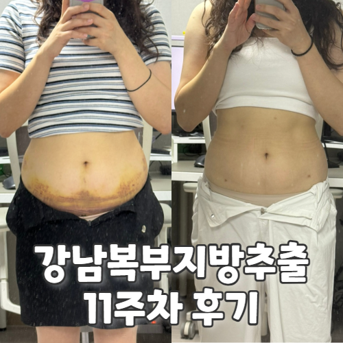  강남 지방추출주사 복부 후기, 11주 부작용 붓기 효과