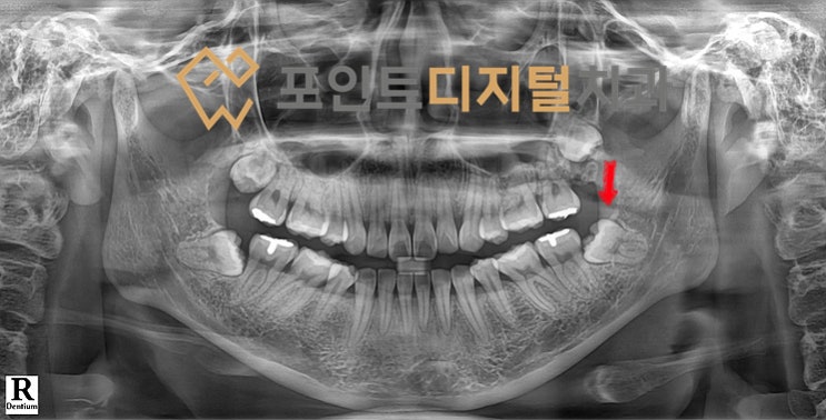  [탕정치과]  방문한 치과 4곳에서 발치 불가능하다고 하여 내원하신 환자분(매복사랑니) / 천안 아산 불당 배방