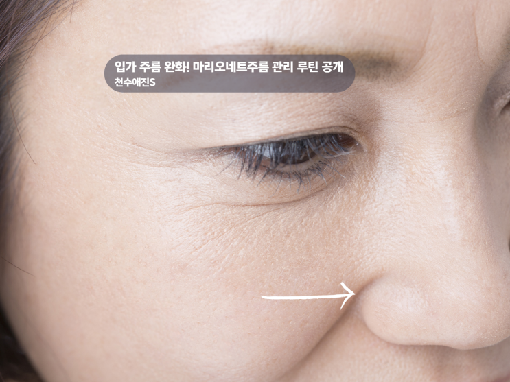  마리오네트주름 완화 천수애진S 후기