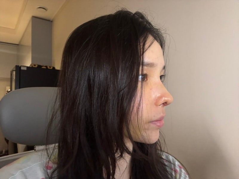 기능 코성형 후기, 매부리 화살코 개방형 내돈내산 코수술 후기 (실비보험 청구)