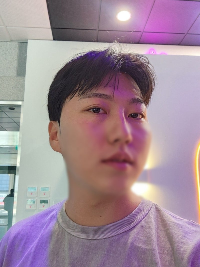 서울남자눈성형 안검하수 남자쌍수 눈매교정 3개월차 후기