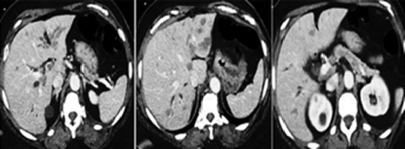 유육종증(Sarcoidosis)에 의한 육아종성 간염