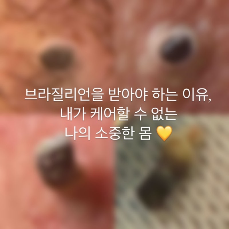 외음부 피지낭종, 알고 보면 사소하지 않은 신호! 브라질리언 왁싱의 중요성❤️