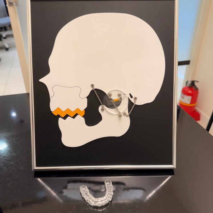 아침마다 턱이 아픈 당신, 꼭 보톡스만이 답일까? 이갈이 마우스피스 vs 보톡스 비교, 효과와 비용 완벽 비교!