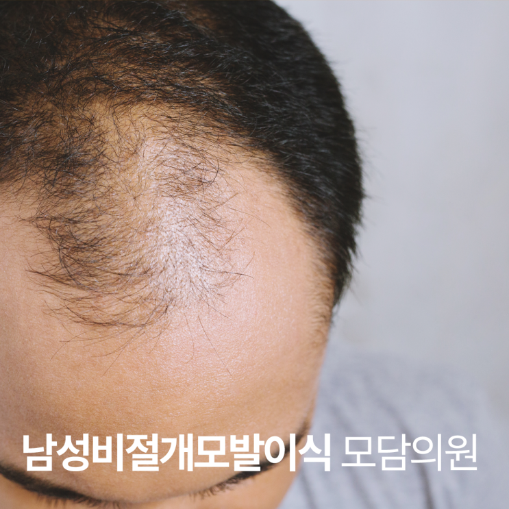  광주 비절개 모발이식, 남성 모발이식 잘하는 병원 고르는 법