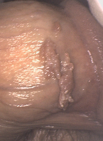 남성 곤지름 원인, 재발 유발하는 HPV 전염 막는 법