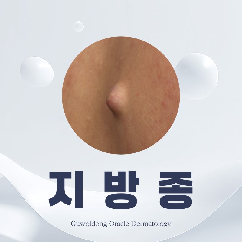 인천구월동오라클피부과 전문의 지방종이란? 원인부터 수술 과정까지 알아봅니다