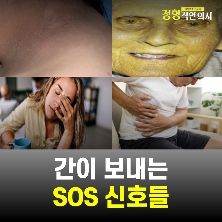  이 5가지 증상, 그냥 두면 간이 위험합니다.  (의사작성)