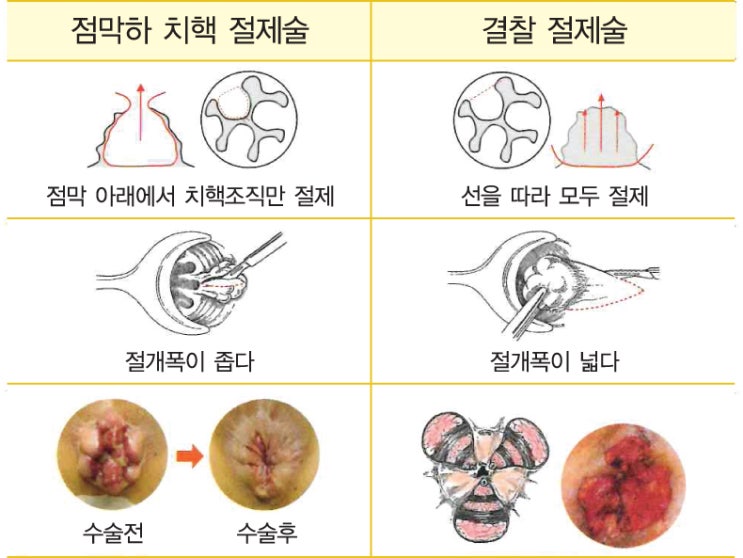  치질 수술, 건강보험 적용 시 얼마? 20만~40만 원 실제 비용 공개!