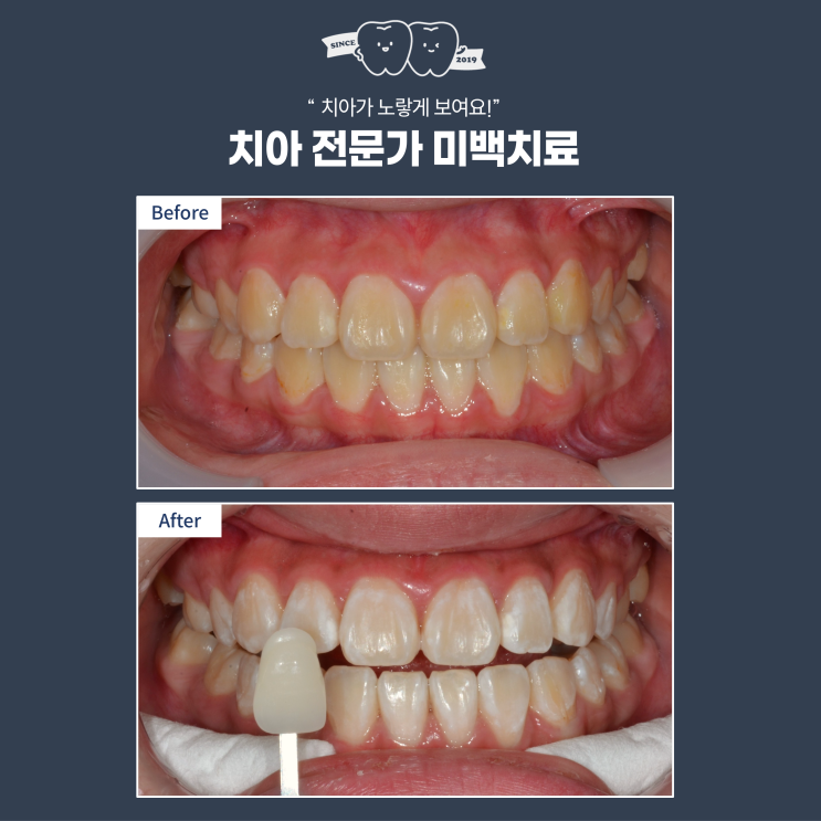  전문가 치아 미백, 효과부터 주의 사항까지 총정리! 라미네이트 말고 미백치료!