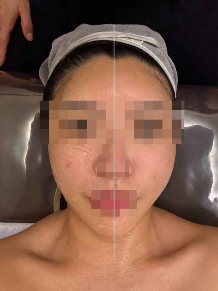  사상피부관리 에스테틱 사상 초강력 하이핏 작은 얼굴 만들기 : 에스티 에스테틱