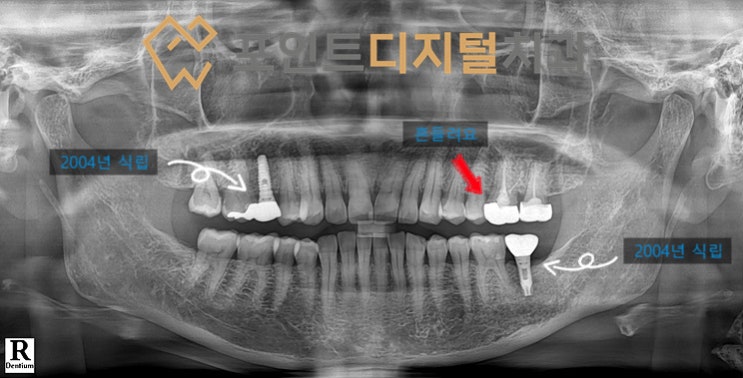  [탕정치과]  치아파절로 발치(발치즉시 임플란트) + 디지털 가이드 + 하이니스 디지털 보철 / 천안 아산 불당 배방
