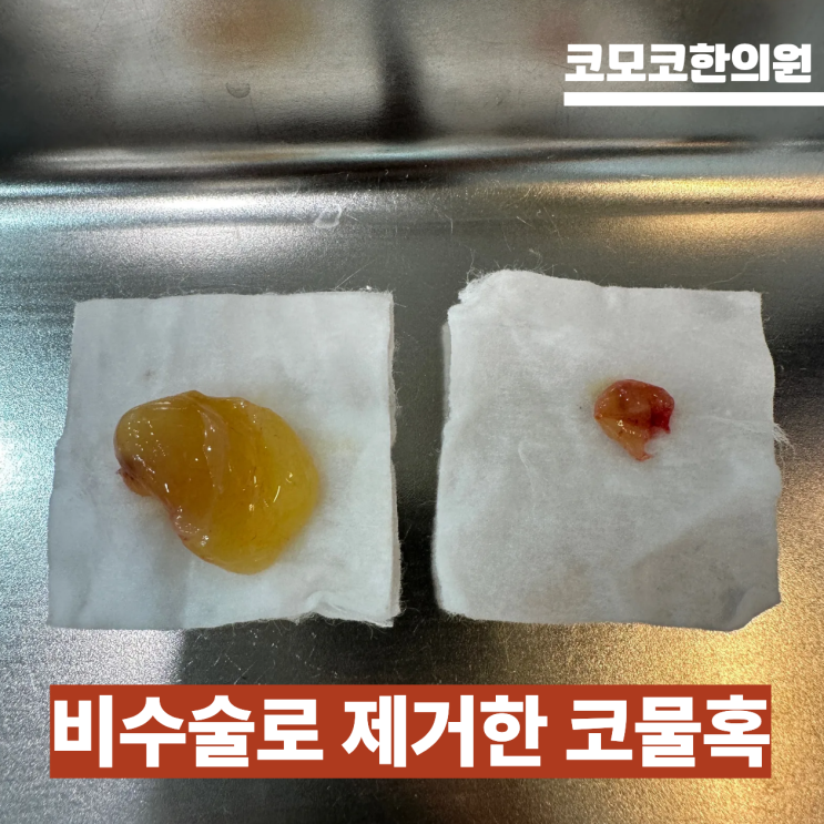  코물혹 한의원에서 제거한 코물혹 사진들 및 후기