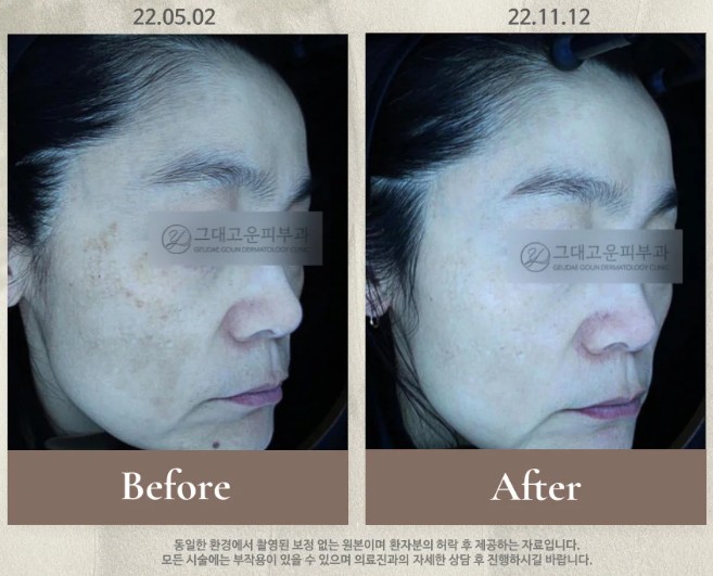  부산 기미레이저, ‘이것’ 하나만 다르면 결과가 달라집니다
