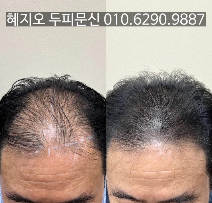  인천 남성 두피페인팅 가격정보 및 무료상담 혜택 안내