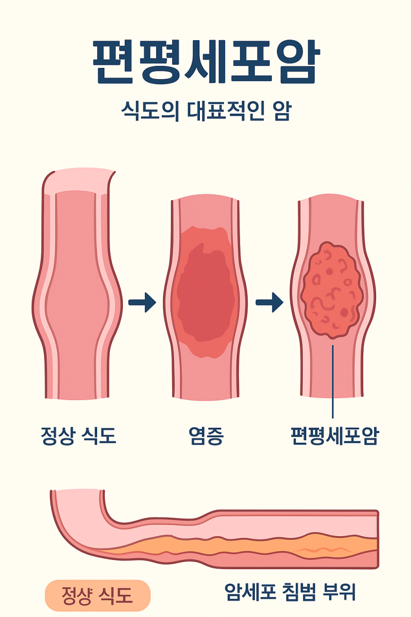 “식도암의 80%는 이것! 편평세포암 원인·증상·예방 총정리”