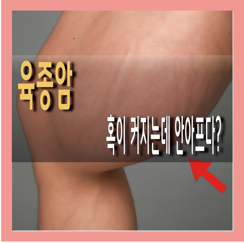 육종암 증상 원인, 조기 진단 중요성 총정리