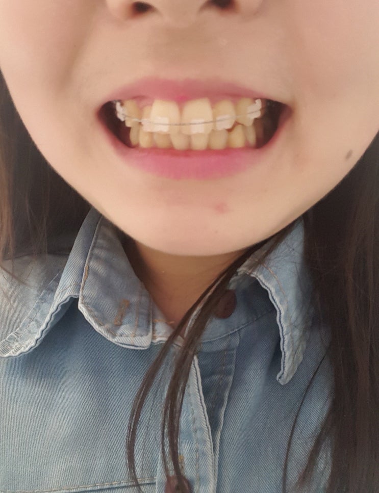  셀프로 치아미백 도전 2주 써본 솔직한 변화 후기