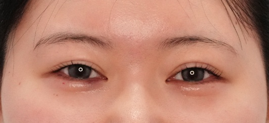  신논현 애교필러, 의사도 반드시 체크하는 3가지