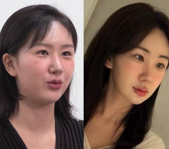  홍대 피부과 추천 아비쥬 올타이트 리프팅