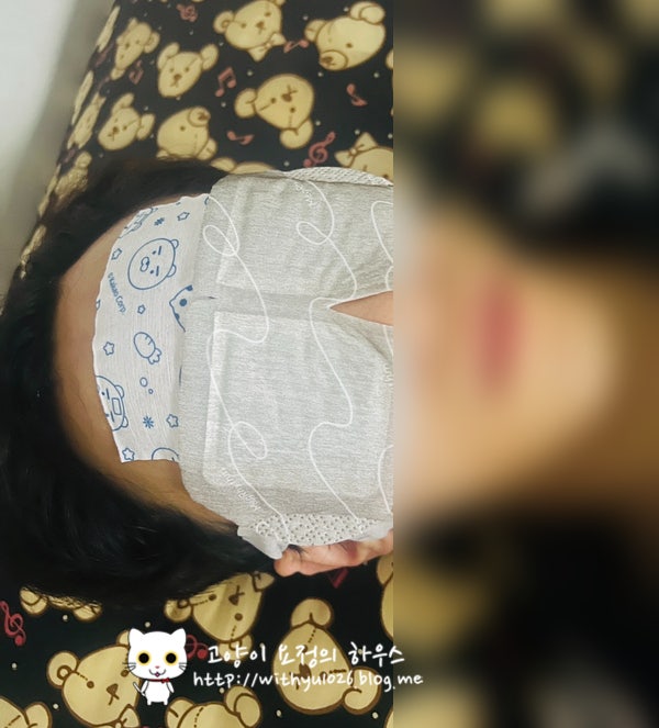  남편인생 첫 성형수술 후기 - 3. 내시경이마거상술+추미근 절제 후기(3일차 ~ 8일차 실밥제거 후기)