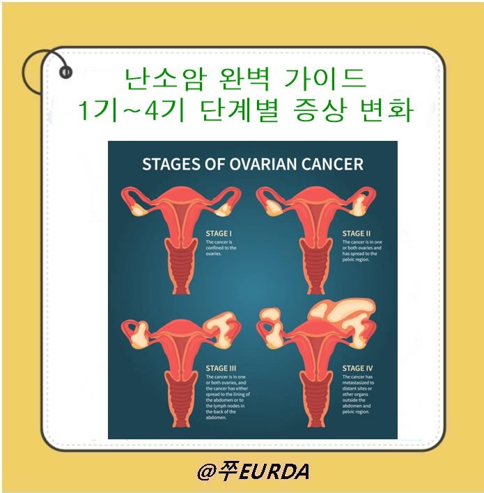 난소암 단계별 증상 차이 정리｜1기부터 4기까지