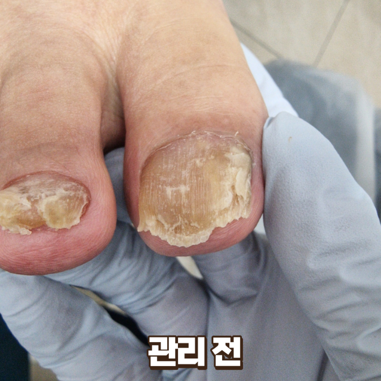  송도내성발톱 삶의 질 수직 상승시키는 문제성 발관리센터 발을