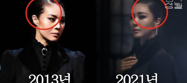 <b>옥주현</b>, <b>모발 이식</b> 후 <b>부작용</b> 고백 - 헤어라인의 충격