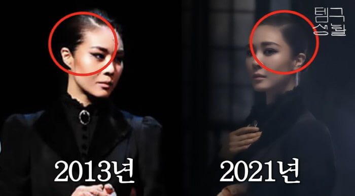 <b>옥주현</b>의 <b>모발 이식</b> 후 겪은 괴로운 이야기