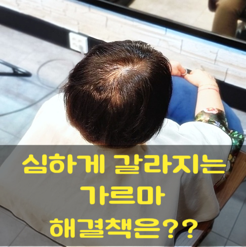  가르마 갈라짐 심한 50대 여성, 정수리 링거펌으로 자연스럽게 해결!