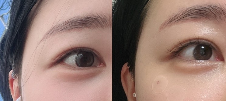  부산 눈밑 필러 내돈내산 리얼후기 | 눈밑지방재배치 후 눈밑꺼짐 교정