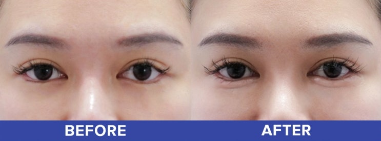  강남 애교필러 처음이라면? 자주 묻는 질문 7가지 정리