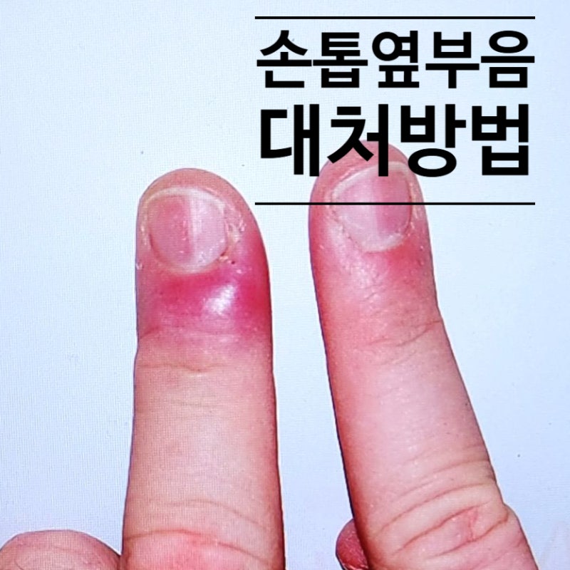 손톱 옆 부음 단계별 대처법