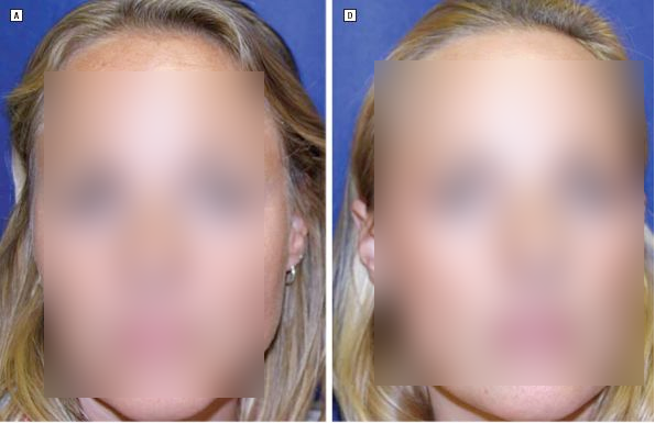  보톡스 10년 맞으면? 쌍둥이 실험결과 보고 이마보톡스 맞고 온 후기 부작용