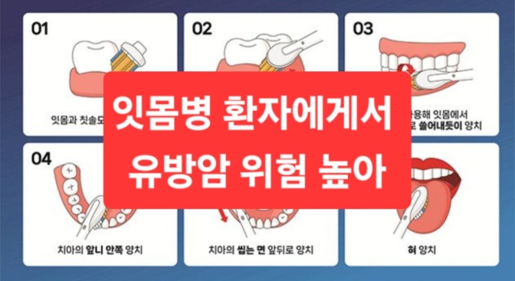  잇몸병 환자에게서 유방암 위험 높아