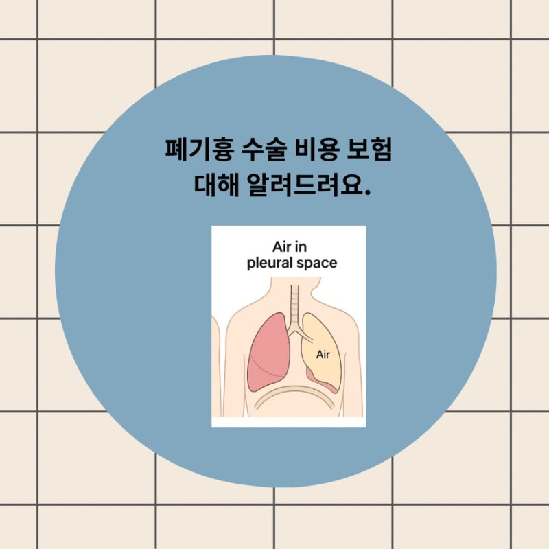 폐기흉 수술 비용 보험 대해 알려드려요.