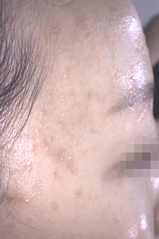 얼굴 편평사마귀 제거, 식초의 효과?