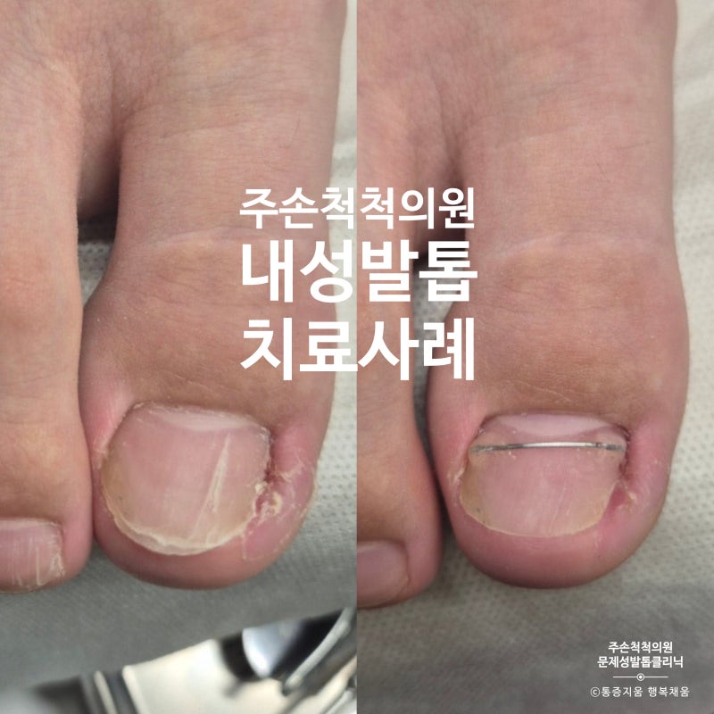 내성발톱 때문에 고생중이라면 인천 내성발톱 치료 잘하는 병원