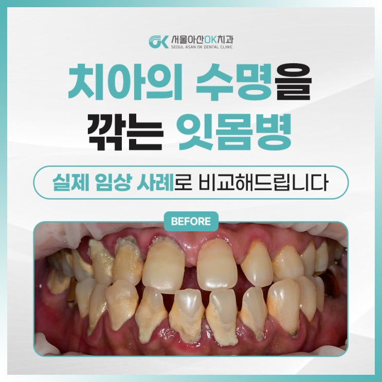  [임상사례] 치아의 수명을 깎는 미사잇몸병