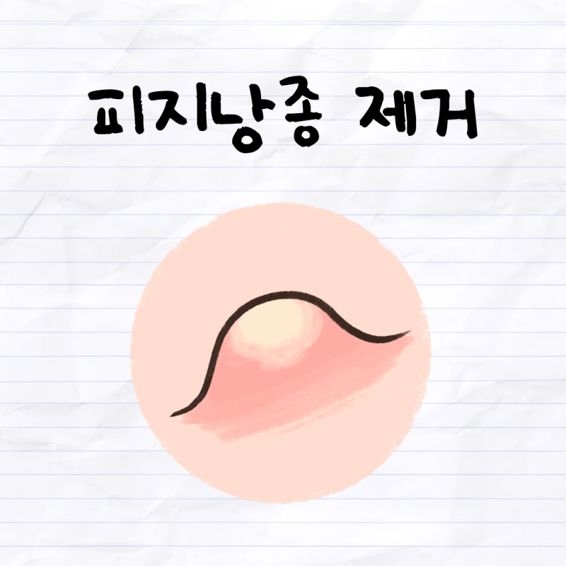 피지낭종 자연치유 가능할까? 셀프제거, 연고, 제거방법