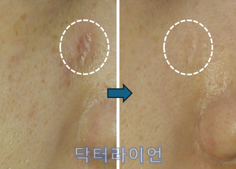 대상포진 흉터 치료 사례ㅣ10회 복합레이저로 말끔히 개선된 실제 전후 & 치료방법 총정리